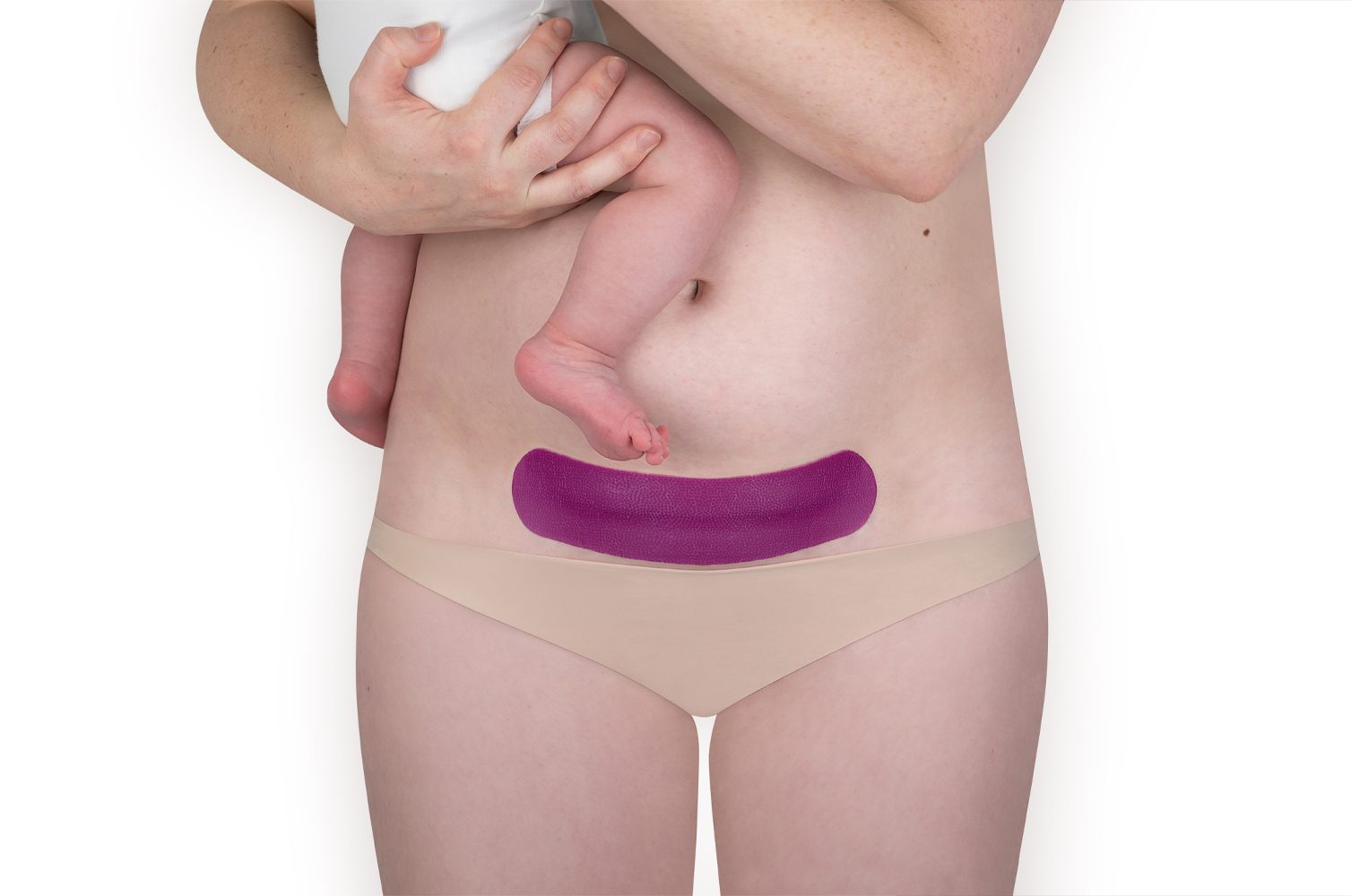 Scarban C-Section siliconenpleister voor littekens na keizersnede